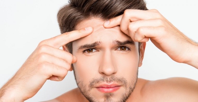 Taníny v čiernom čaji uzatvárajú póry a pomáhajú proti akné a pupienkom