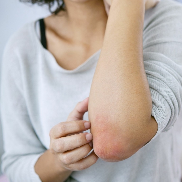 Na zmiernenie vyrážok a ekzémov používajte zábaly z čierneho čaju