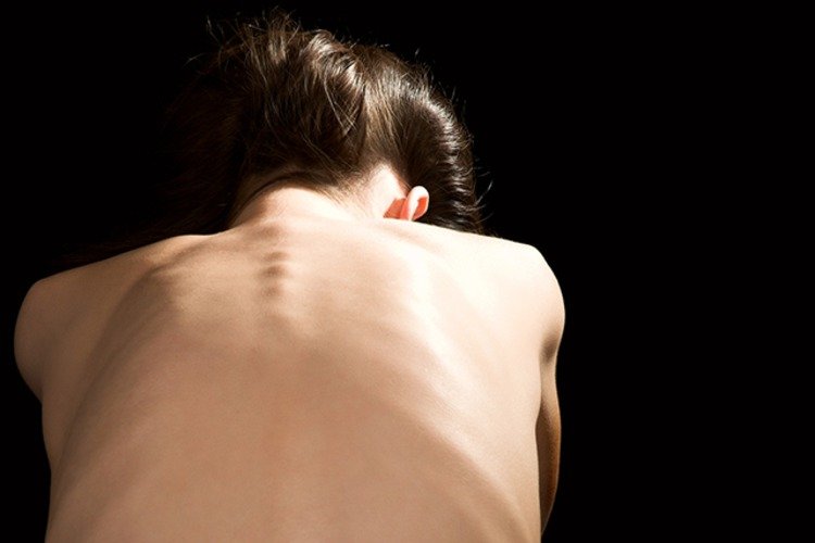 stav kachexie pri rakovine alebo strate svalovej hmoty v dôsledku oslabeného imunitného systému