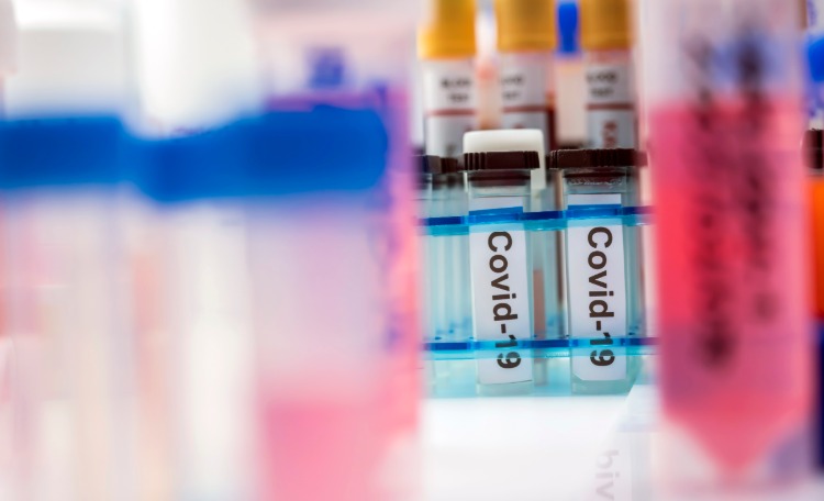 vzorky v pohároch so sars-cov 2 covid 19 v laboratóriu