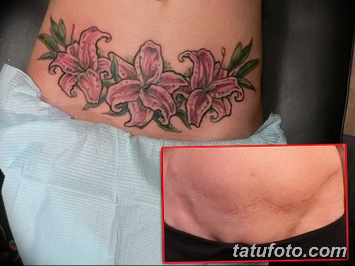 снимка Татуировка върху белег от цезарово сечение от 23.09.2017 г. No 040 - Цезарово сечение -