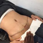 снимка Татуировка върху белег от цезарово сечение от 23.09.2017 г. No 022 - Цезарово сечение -