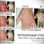 Uklanjanje tetovaža - foto prikol 4