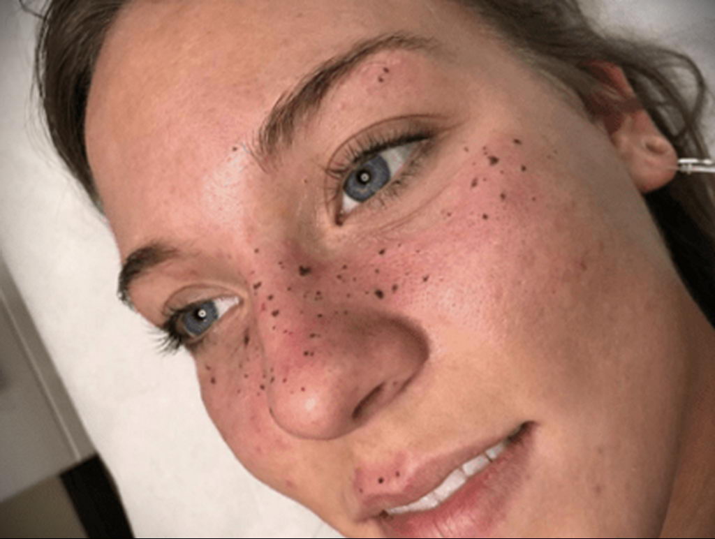 fotografija tetovaže pjegica na licu 2