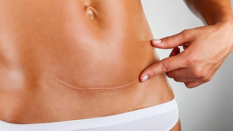 Po cisárskom reze budete cítiť zášklby, pretože sa nervy samy obnovia